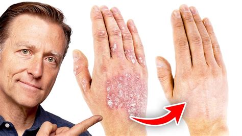 How Do You Cure Eczema