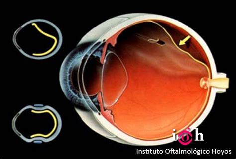 Desprendimiento de retina Instituto Oftalmológico Hoyos