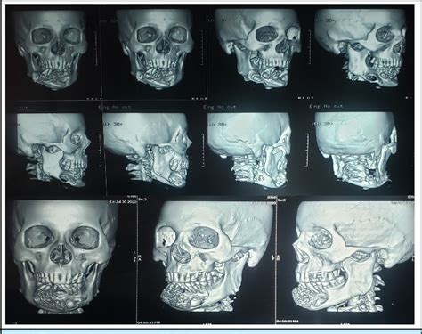 Figure From Unicystic Ameloblastoma Of Mandible A Case Report