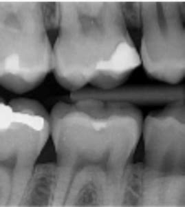 Radiografia Interproximal Imagem Radiologia