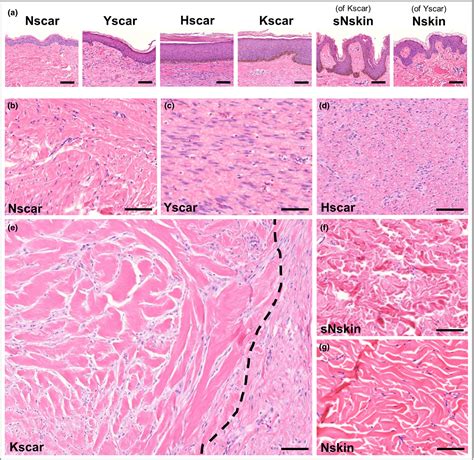 Hyperplastic Tissue