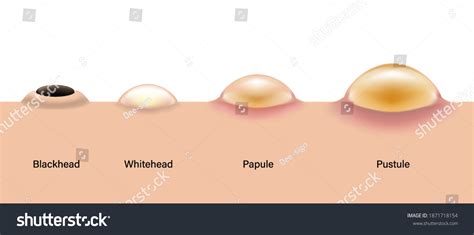 Type Acne Diagram Skin Acne On Stock Vector Royalty Free 1871718154