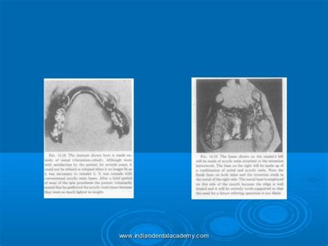 Denture Base Considerationscertified Fixed Orthodontic Courses By In