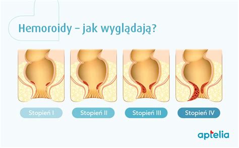 Hemoroidy czym są jak wyglądają Objawy hemoroidów aptelia pl