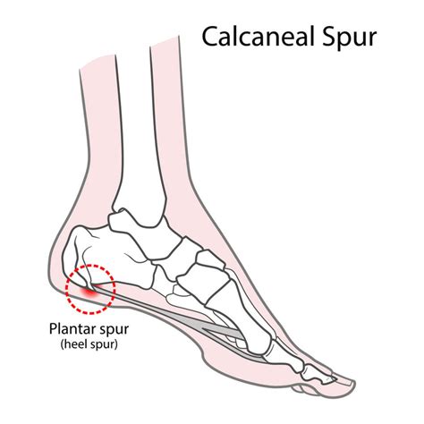 Calcaneal Spur treatment – HappyWalk - Orthopedic & Diabetic Footwear Store