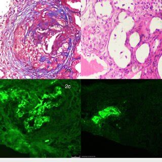 A Massive Cellular Crescents With Peri Glomerular Fibrosis Masson