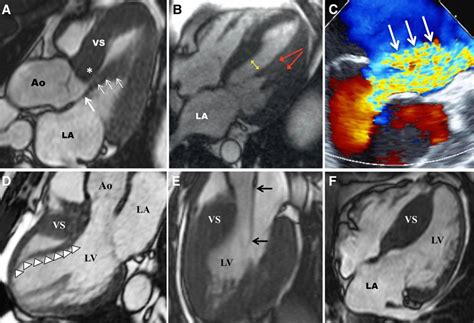 How To Image Hypertrophic Cardiomyopathy Circulation Cardiovascular