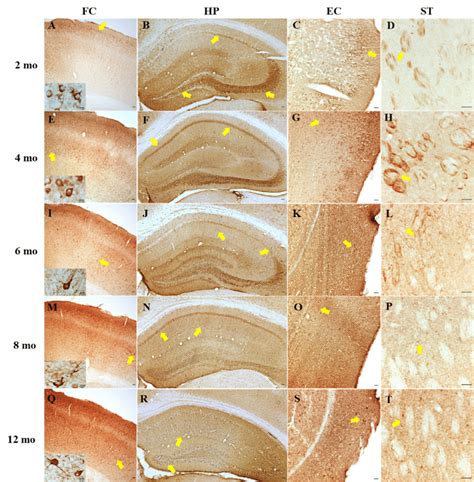 Immunohistochemistry With The At8 Antibody Showing Phosphorylated Tau