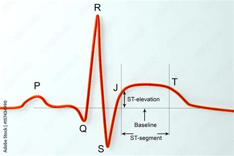 Ecg In Myocardial Infarction 3d Illustration Showing St Elevation