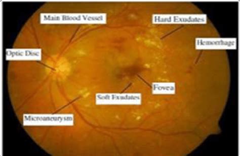 Pathological Features Of Retinal Image Of Typical Diabetic Retinopathy