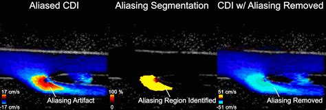 Removing Aliasing Artifacts In Ultrasound Color Doppler Imaging With Nvidia Clara Holoscan And