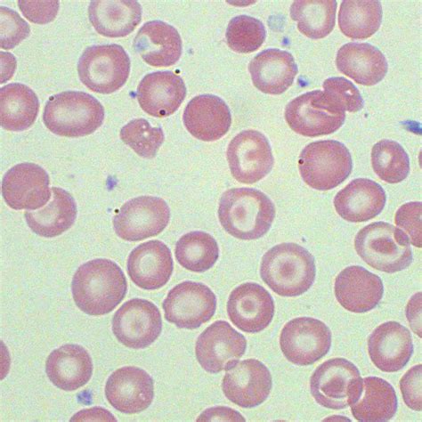 Target Cells Test Findings MedSchool