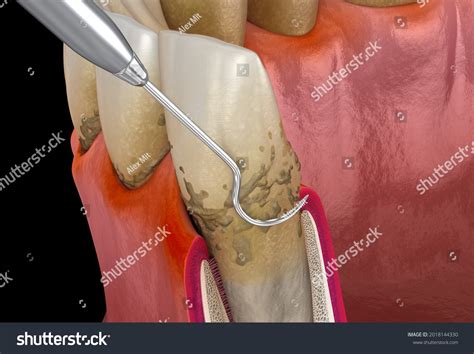 Oral Hygiene Scaling Root Planing Conventional Stock Illustration 2018144330 Shutterstock