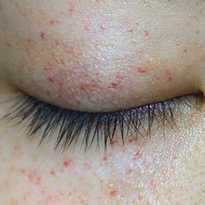 Red Dots Around Eyes: Causes, Treatment, and When to Worry