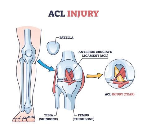 Tackling The Challenge The Pervasive Threat Of Acl Tears In Football