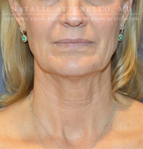 Beverly Hills Facelift Before and After Photos - Los Angeles Plastic ...