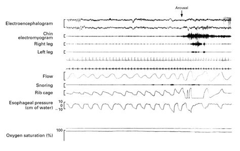 Upper Airway Resistance Syndrome — Nejm