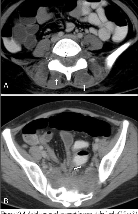 Figure From Spinal Epidural Abscess A Rare Complication Of