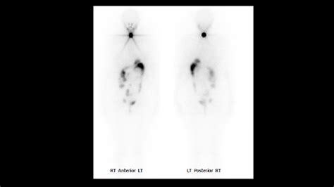 Radioactive Iodine Scan