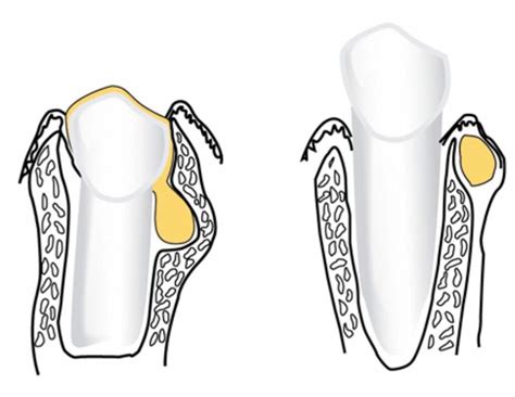 What Is a Gingival Cyst? Causes & Symptoms – Trust Dental Care