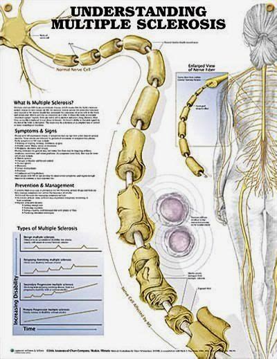 Pin By Michael On Health Multiple Sclerosis Multiple Sclerosis