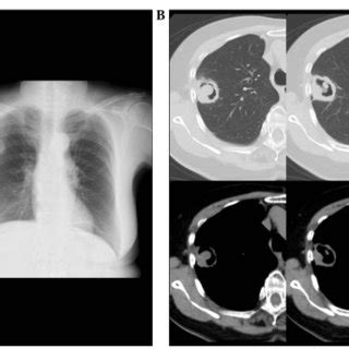 Initial Chest X Ray And Ct Findings A Plain Chest X Ray Showing A