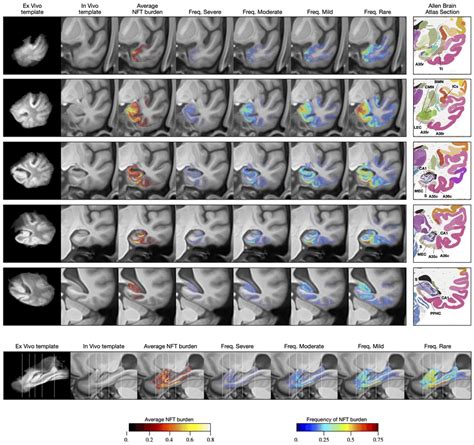 Average And Summary Maps Of Tau Neurofibrillary Tangle Nft Burden In