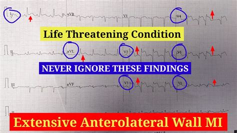 Extensive Anterior Wall Myocardial Infarction Ecg Interpretation