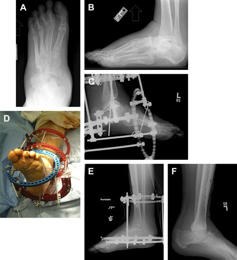 Surgical Reconstruction Of The Charcot Rearfoot And Ankle Clinics In