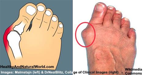 How To Get Rid Of Bunion Pain Without Surgery