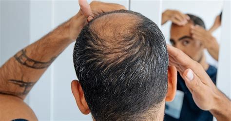 Men using finasteride for hair loss 'at risk' of missing prostate ...