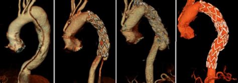 Angio Ct D Reconstruction Of Type B Aortic Dissection Before Surgery