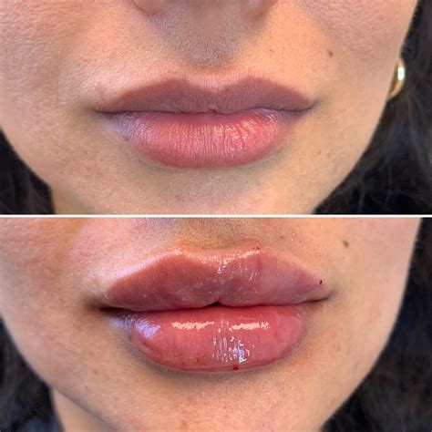 Lip Filler Russian Lips Lip Fillers Botox Fillers Lips