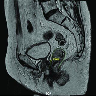 Sagittal Plane Of Preoperative T Weighted Mri The Neovagina Is