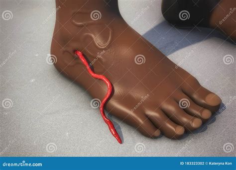 Guinea Worm Disease, Dracunculiasis Stock Illustration - Illustration of worm, medicine: 183323302