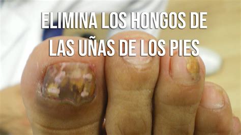 C Mo Eliminar Los Hongos En Las U As De Los Pies Youtube