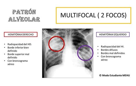 Patr N Alveolar Multifocal Radiolog A Cl Nica Udocz