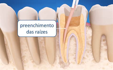 Como Feito Canal No Dente Msk Odontologia