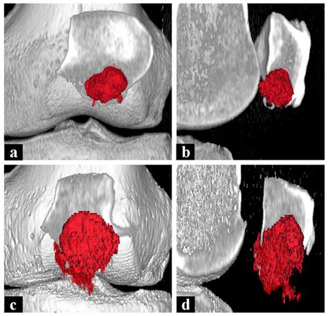 Ct Scans With Three Dimensional Reconstruction And Volume Analysis