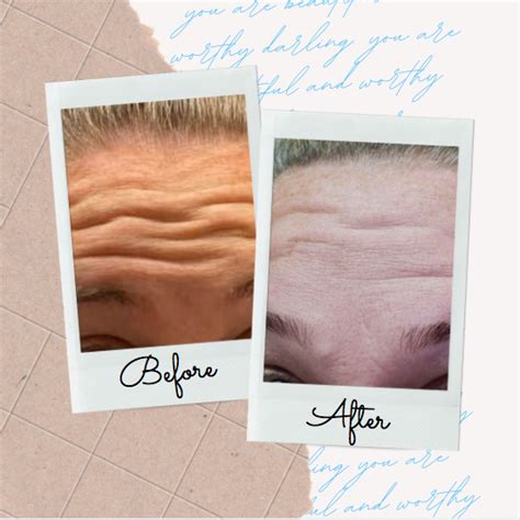 Achieve Ageless Beauty With Anti Aging Treatments