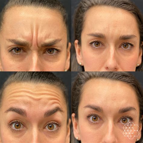 Top 5 Facial Areas For Botox Treatments