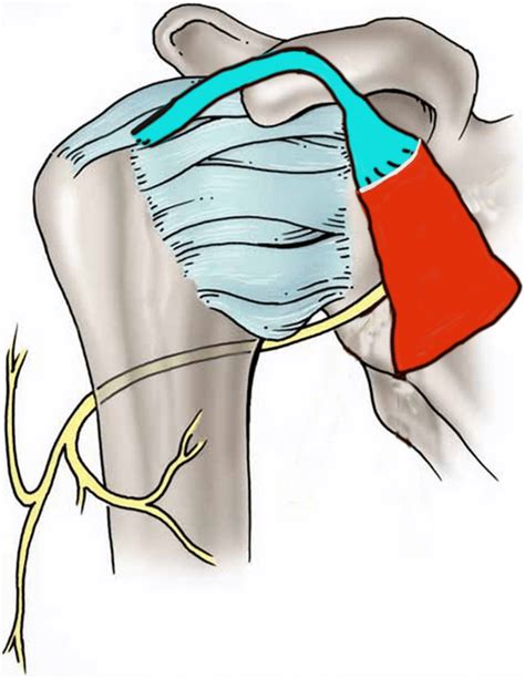 Schematic Drawing Of A Pectoralis Minor Tenon Teal Color Of Insertion Download Scientific