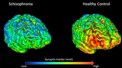 A Freshly Tweaked Brain Scanning Method Has Revealed How People With