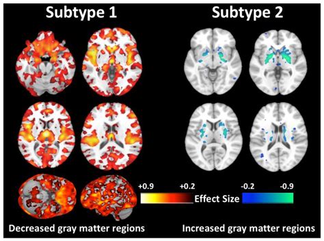 Disorganized Schizophrenia Brain