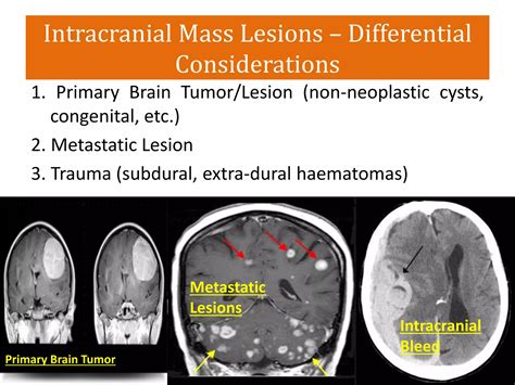 Intracranial Space Occupying Lesions Ppt