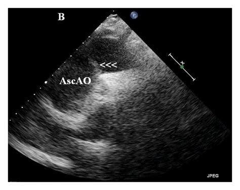 Transthoracic Echocardiogram In Suprasternal View Showing Dissection