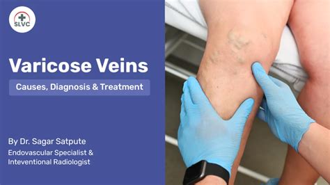 Varicose Veins - Causes, Diagnosis & Treatment