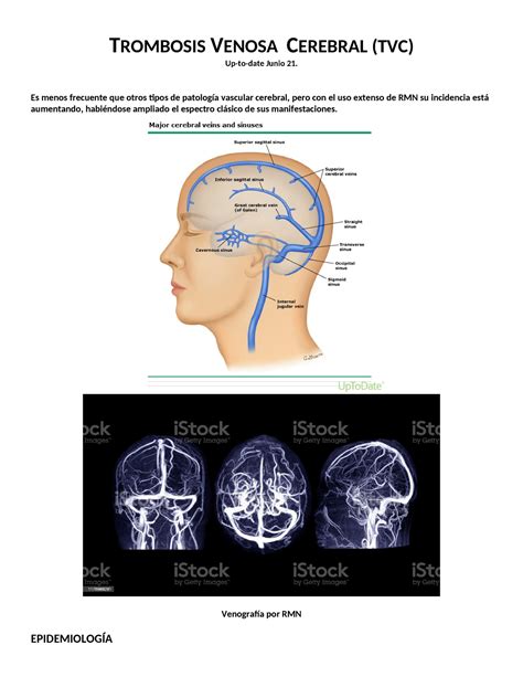 Trombosis Venosa Cerebral Trombosis Venosa Cerebral Tvc Up To Date Junio 21 Es Menos