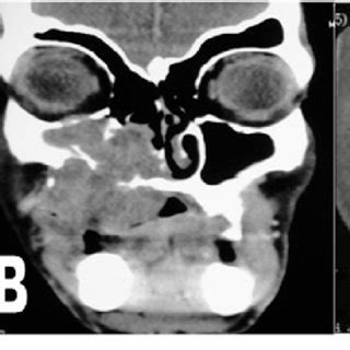 Pdf Tips And Tricks In Surgical Management Of Maxillary Sinus Tumors