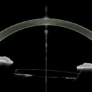 Optical Coherence Tomography Anterior Segment Scan Imaging Iol Optic